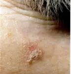 Macchie rosa della pelle e cheratosi attinica: danni da abbronzatura. Cura cheratosi attinica