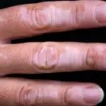 Macchie bianche sulla pelle: cura della vitiligine. Fototerapia e trapianto di melanociti