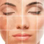 Cause melasma del viso nella donna: macchie marroni del viso e trattamenti estetici