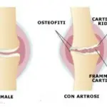 Cura artrosi cervicale e lombare, artrosi anca e ginocchio, artrosi caviglie, mani, gomito