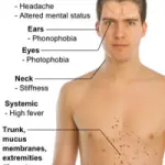 Sintomi meningite virale e batterica. Cause meningite e contagio. Vaccino meningite e cura