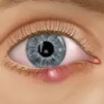 Sintomi e cura orzaiolo e calzaio all' occhio: ascesso e cisti all' occhio