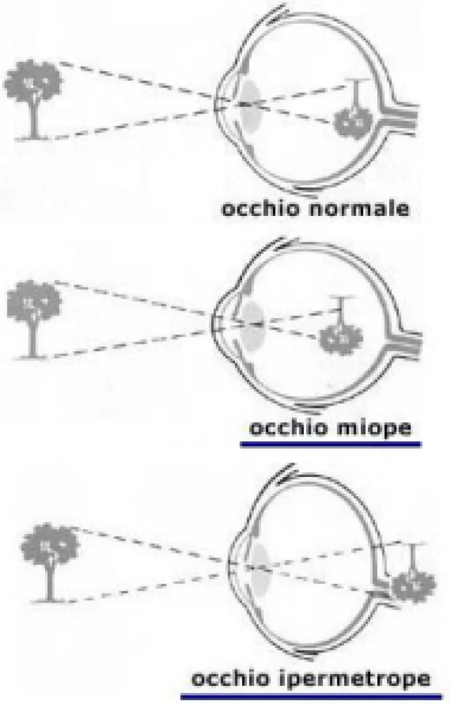Ipermetropia: vedere male da vicino e lontano. Correzione laser ipermetropia e sostituzione cristallino