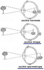 Ipermetropia: vedere male da vicino e lontano. Correzione laser ipermetropia e sostituzione cristallino