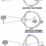 Ipermetropia: vedere male da vicino e lontano. Correzione laser ipermetropia e sostituzione cristallino