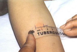 Contagio tubercolosi: sintomi, diagnosi e cura tubercolosi. Malattie Infettive