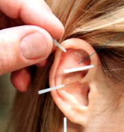 Auricoloterapia: smettere di fumare, controllo fame nervosa, cura mal di testa cronico, insonnia