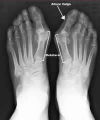 Sintomi alluce valgo e cura: operazione per alluce valgo (piede). Nuovo intervento chirurgico