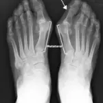 Sintomi alluce valgo e cura: operazione per alluce valgo (piede). Nuovo intervento chirurgico