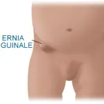 Sintomi ernia inguinale, diagnosi e cura. L' intervento chirurgico per l' ernia inguinale