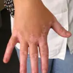 Cura vitiligine (macchie bianche pelle) con Microfototerapia a luce fredda