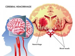 Cause emorragia cerebrale e ictus: pressione alta, stress, rabbia, alcol e droghe