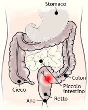 Tumore intestino colon-retto e polipi: diagnosi tumore colon-retto e cura