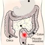 Tumore intestino colon-retto e polipi: diagnosi tumore colon-retto e cura