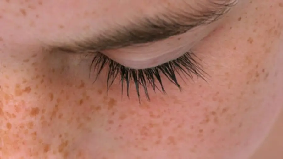 Macchie solari: come riconoscerle ed eliminarle