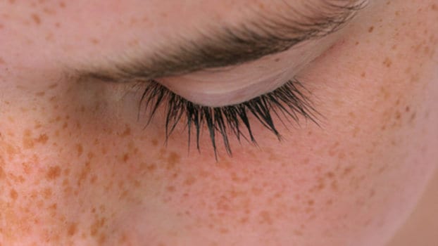 Macchie solari: come riconoscerle ed eliminarle