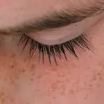 Macchie solari: come riconoscerle ed eliminarle