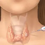 Noduli tiroidei (noduli benigni del collo): diagnosi e cura noduli alla tiroide