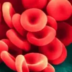 Sintomi anemia (carenza di ferro) da Helicobacter: stanchezza e disturbi digestivi. Diagnosi e cura