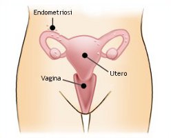 Sintomi endometriosi, diagnosi e cura. Dieta ed endometriosi: alimentazione e salute della donna