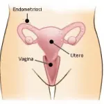 Sintomi endometriosi, diagnosi e cura. Dieta ed endometriosi: alimentazione e salute della donna