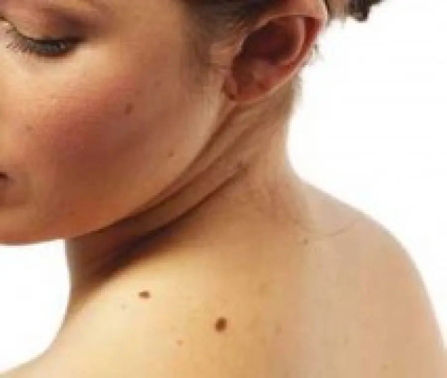 Diagnosi e cura tumori della pelle: melanoma, epitelioma e nei sospetti - Tumori Maligni