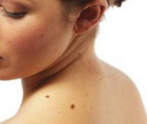 Diagnosi e cura tumori della pelle: melanoma, epitelioma e nei sospetti - Tumori Maligni