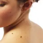 Diagnosi e cura tumori della pelle: melanoma, epitelioma e nei sospetti - Tumori Maligni