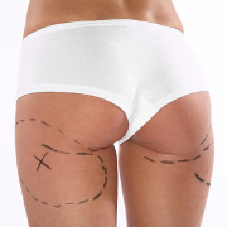 Chirurgia estetica per modellare i glutei: liposcultura e lifting per sollevare i glutei, protesi per glutei piatti