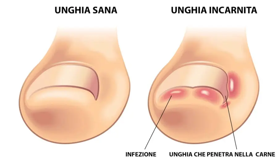 Unghia incarnita: operazione e tempi di recupero