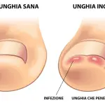 Unghia incarnita: operazione e tempi di recupero