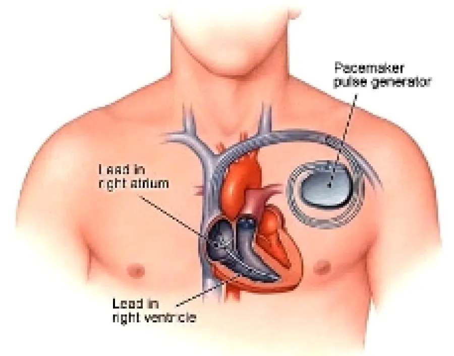 Cura malattie del cuore: il nuovo pacemaker compatibile con la risonanza magnetica. Pacemaker Advisa DR MRI