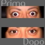 Occhi sporgenti: morbo di Graves e orbitopatia tiroidea (malattia della tiroide). L' intervento chirurgico agli occhi