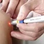 Trattamenti laser per eliminare macchie scure su viso e mani, capillari delle gambe, verruche seborroiche