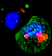Tumore al Seno e Cellule Staminali Tumorali: la ricerca medica sulle cause e sulla cura del tumore al seno 