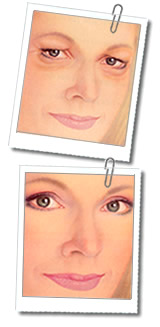 Eliminare occhiaie e borse sotto agli occhi con il mini-lifting dello zigomo: l' alternativa alla blefaroplastica 