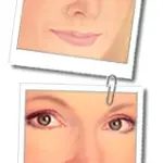 Eliminare occhiaie e borse sotto agli occhi con il mini-lifting dello zigomo: l' alternativa alla blefaroplastica 