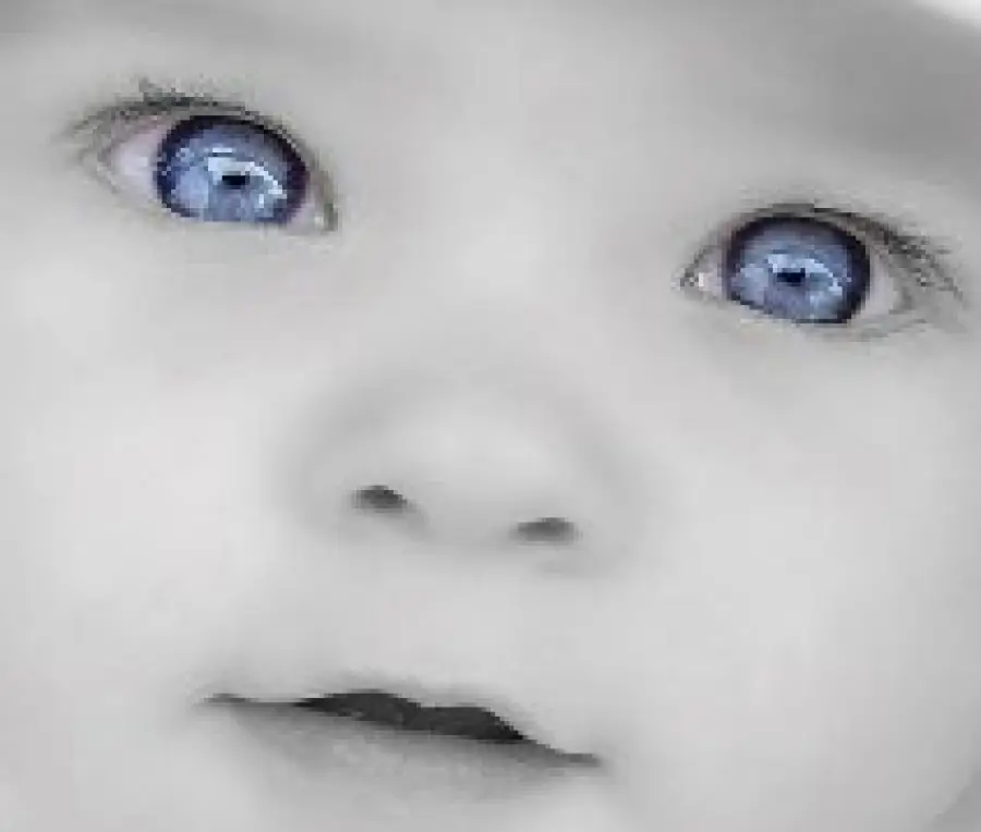 Cura della Ptosi congenita nei bambini: difetto della palpebra degli occhi che non si apre completamente