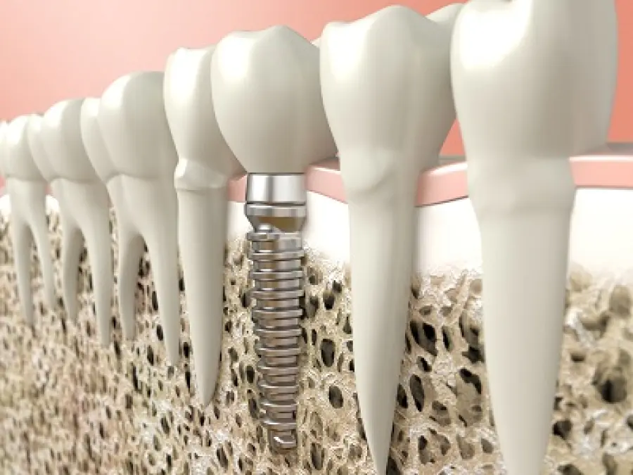 Come riavere denti fissi grazie all' implantologia dentale