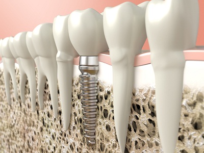 Come riavere denti fissi grazie all' implantologia dentale