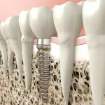 Come riavere denti fissi grazie all' implantologia dentale