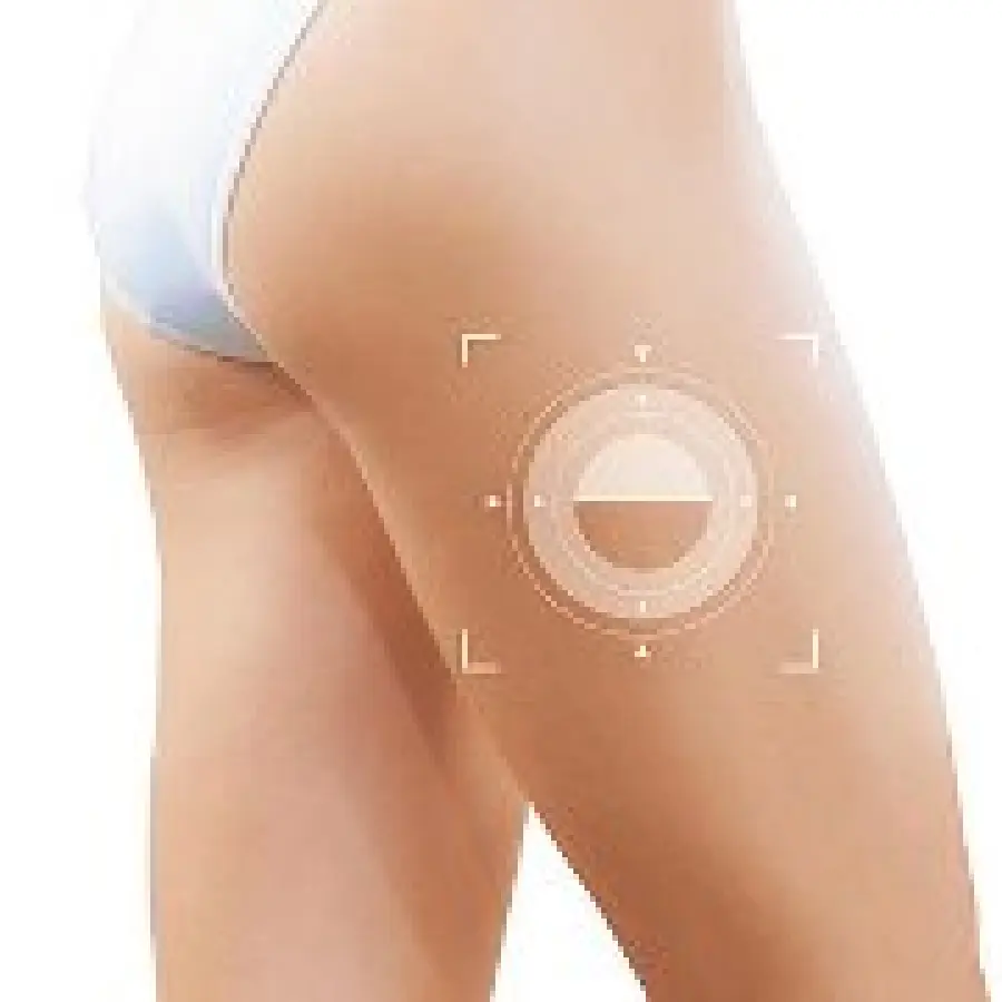 Curare la cellulite con i rimedi naturali anticellulite: estratto d' ananas e centella asiatica contro la cellulite