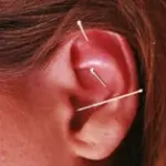 Dieta e agopuntura per dimagrire: l’ agopuntura contro attacchi di fame nervosa da ansia e stress 