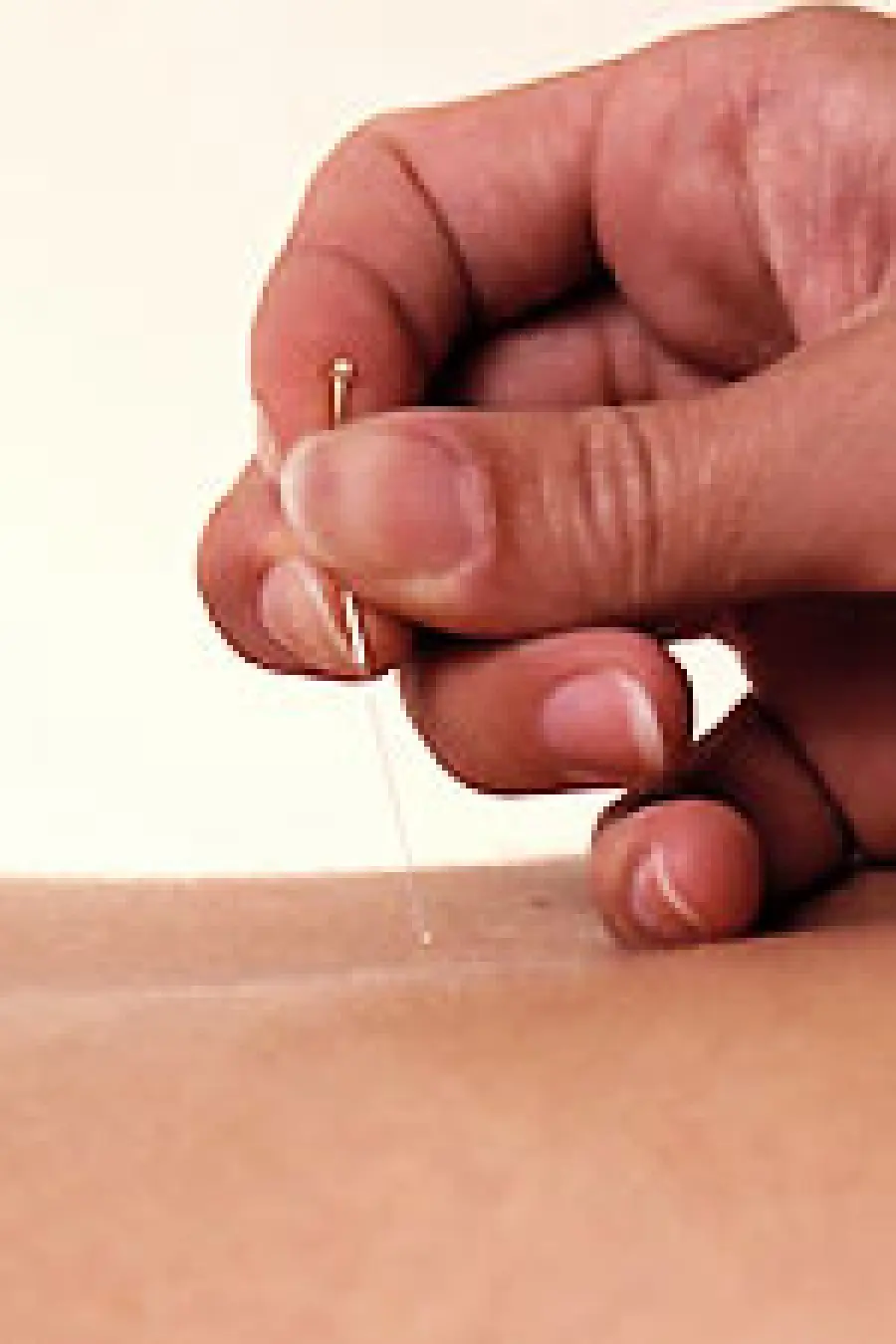 L’ agopuntura contro la cellulite: rimedi per eliminare cellulite, ritenzione idrica e gambe gonfie