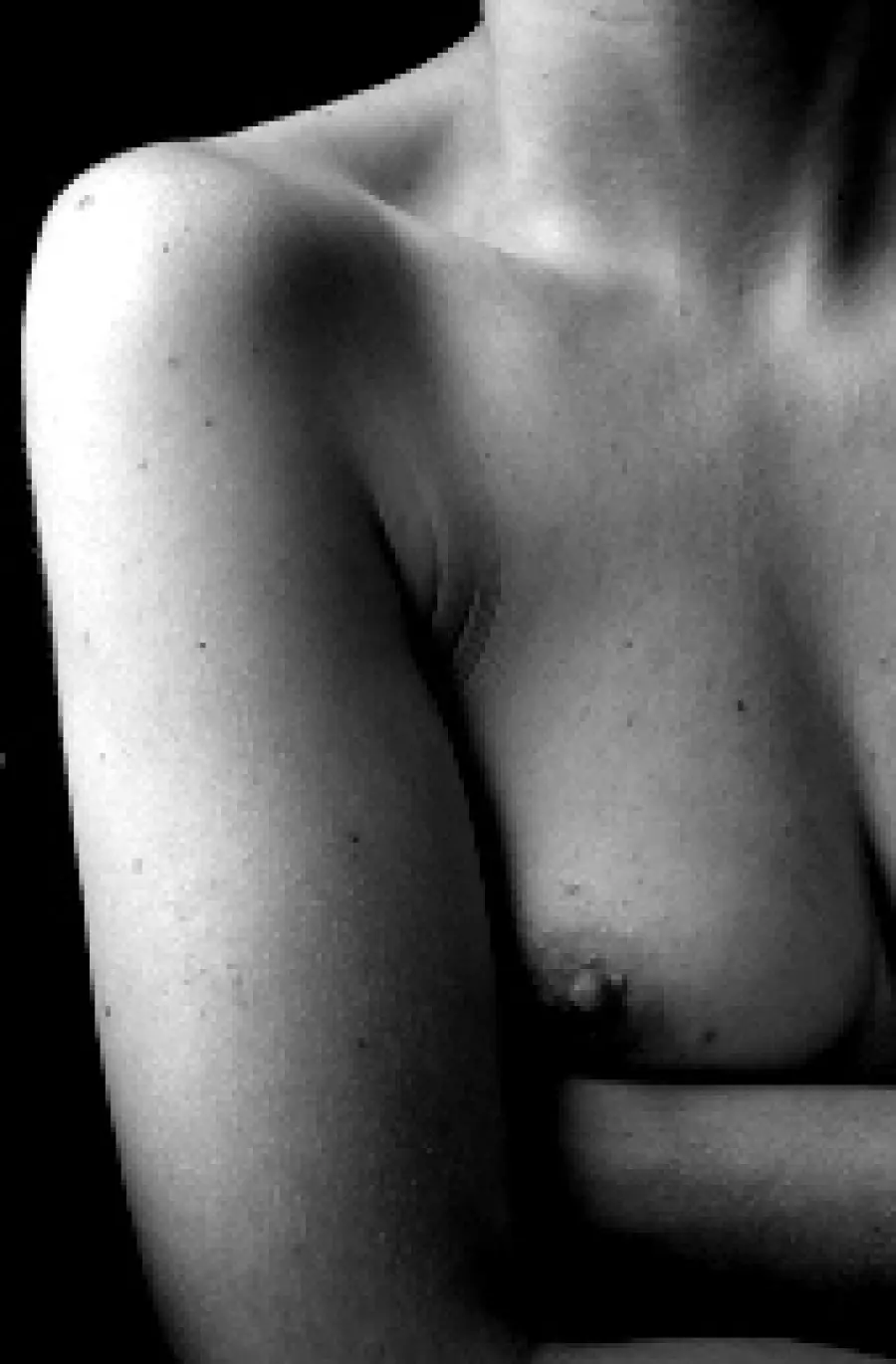 Noduli al seno: sintomi, diagnosi e cura della cisti al seno e del fibroadenoma al seno (tumore benigno)