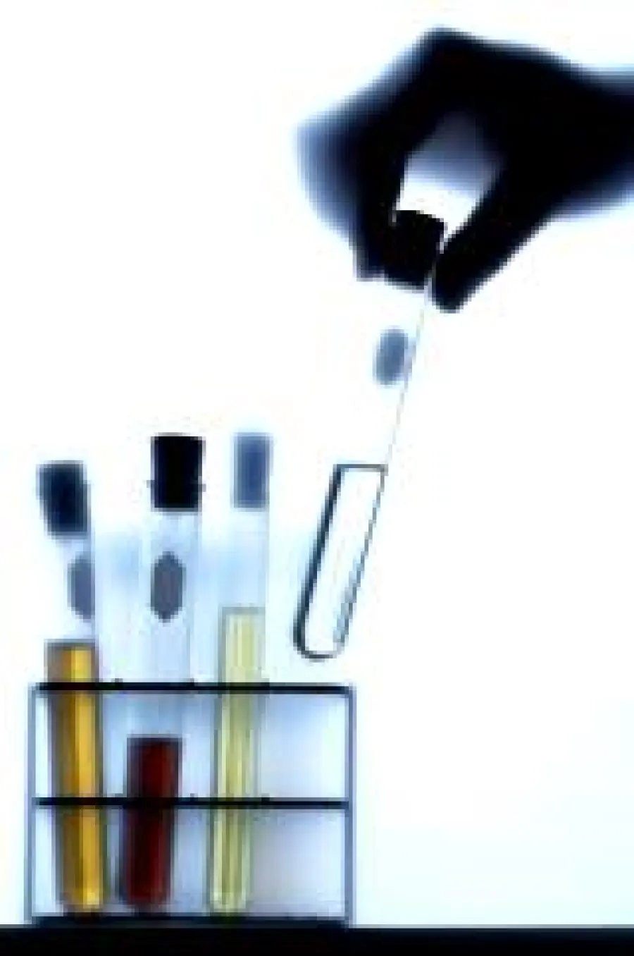 Cura dei noduli tiroidei e tumore della tiroide: la diagnosi con un esame del sangue