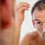 Trapianto capelli: sempre più italiani scelgono le cliniche turche