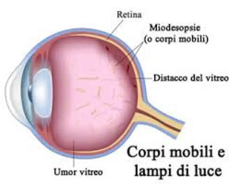 Miodesopsie degli occhi: guarire dalle "mosche volanti"