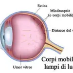Miodesopsie degli occhi: guarire dalle "mosche volanti"