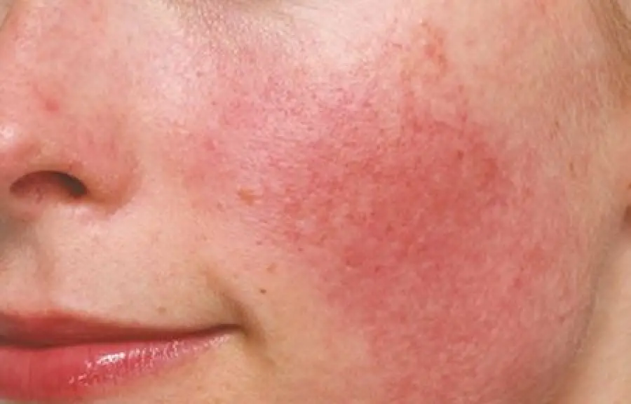 Acne rosacea: cause, sintomi, cura